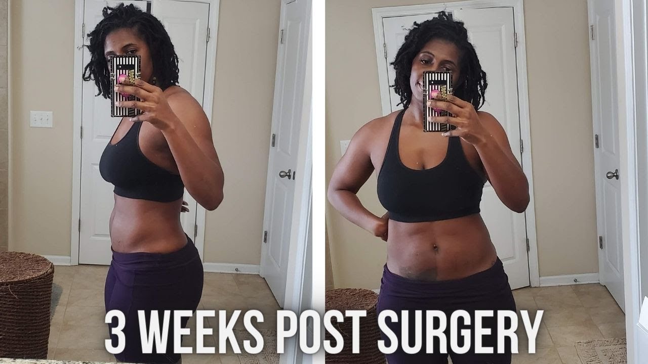 3 WEEKS POST HYSTERECTOMY SURGERY| FINALLY FEELING LIKE MYSELF