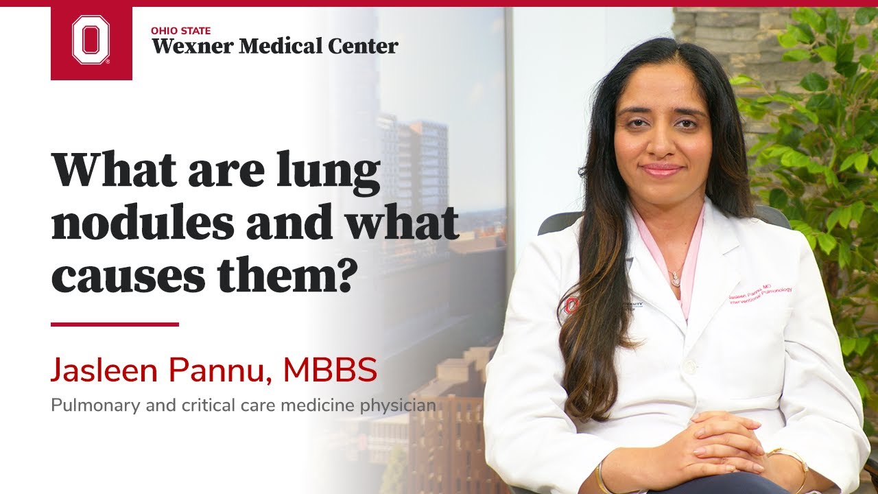 What are lung nodules and what causes them? | Ohio State Medical Center