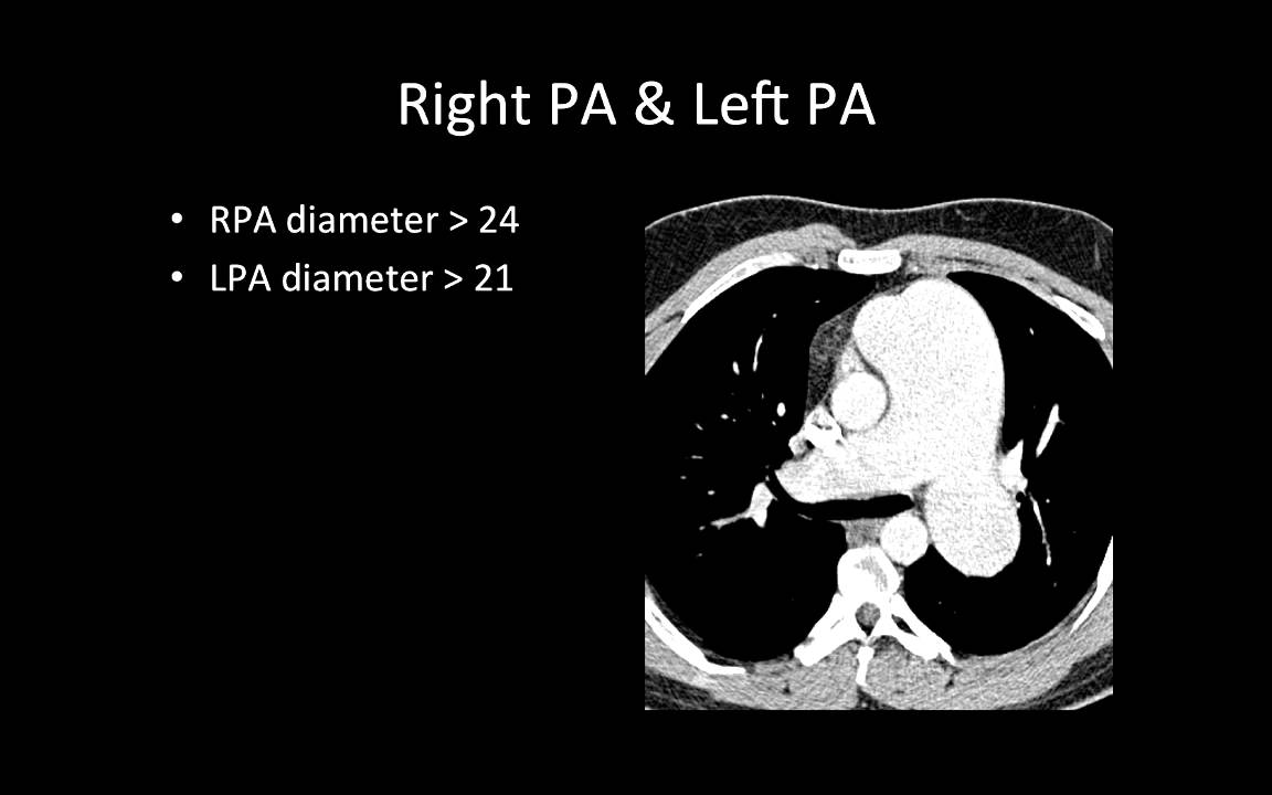 CT and MR Eval of RV Function and Pulmonary Hypertension
