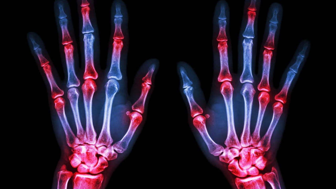 Natural Remedies to Combat Rheumatoid Arthritis
