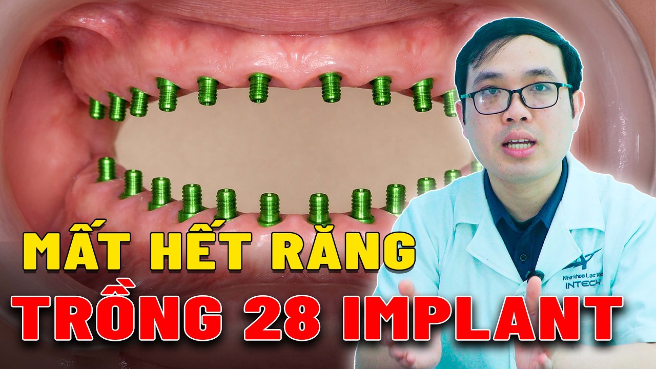 Nếu mất toàn bộ răng bạn có phải TRỒNG 28 TRỤ IMPLANT không?