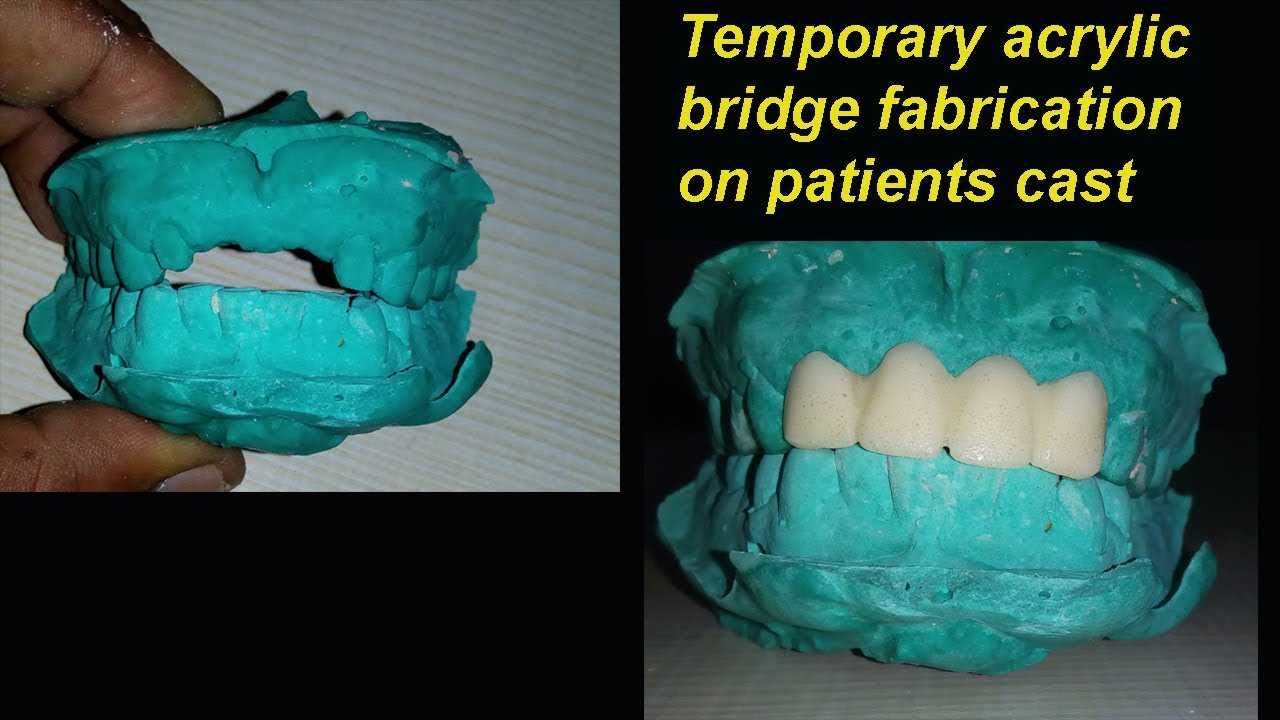 Temporary acrylic bridge fabrication technique on the cast very easy method