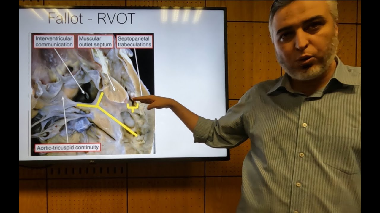 Tetralogy of Fallot (Part 1) - Hatem Hosny