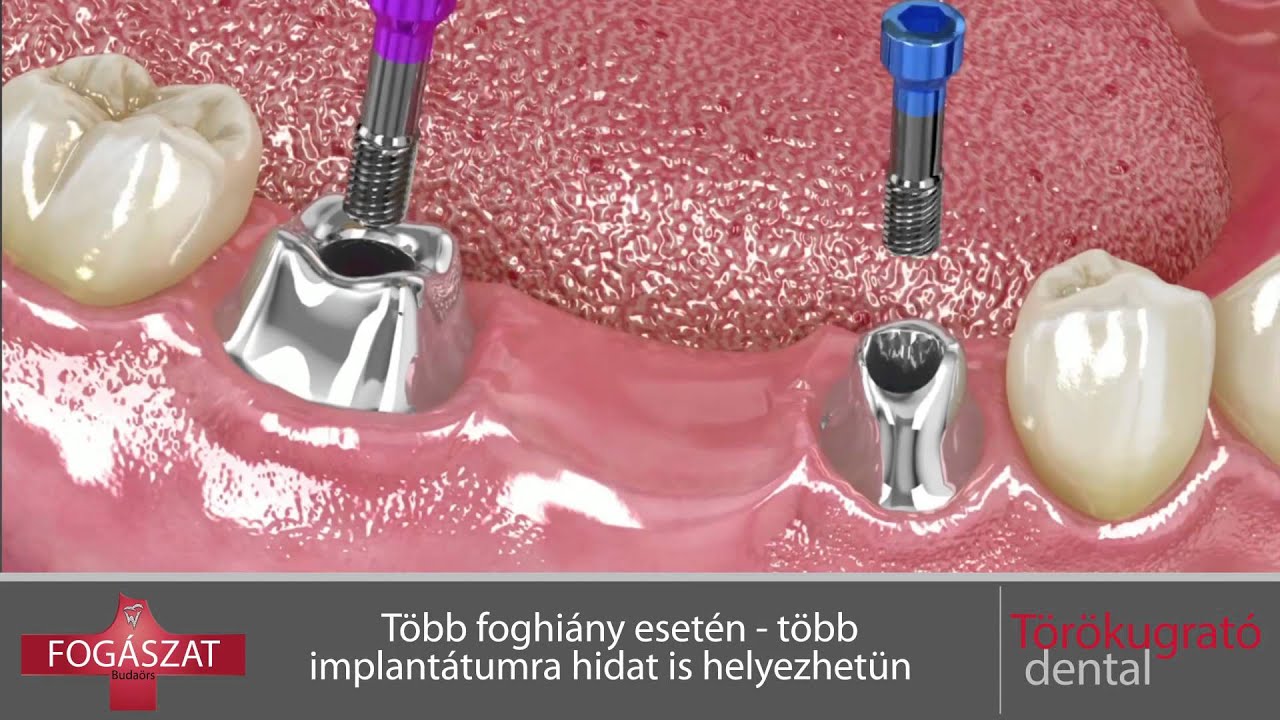 Foghiány pótlása implantátummal: Törökugrató Dental