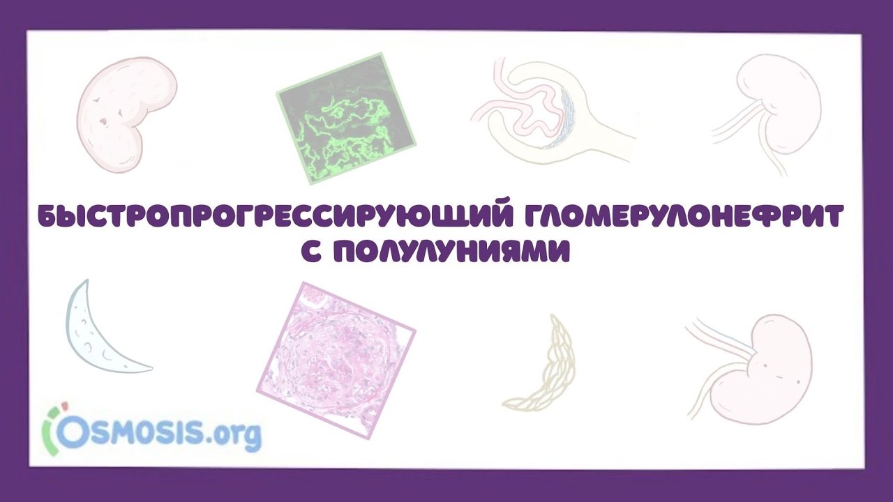 Быстропрогрессирующий гломерулонефрит с полулуниями - причины, симптомы, лечение (лекция)