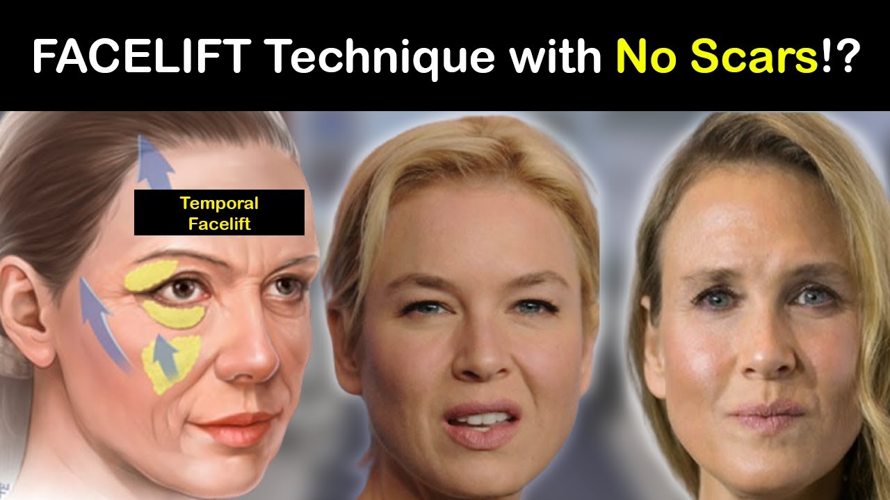 What You NEED to Know About the Scar-Free Ponytail Facelift!