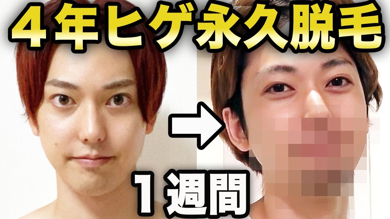 ４年間ヒゲ永久脱毛したらヒゲはもう生えないのか？１週間ヒゲを伸ばしてみた！