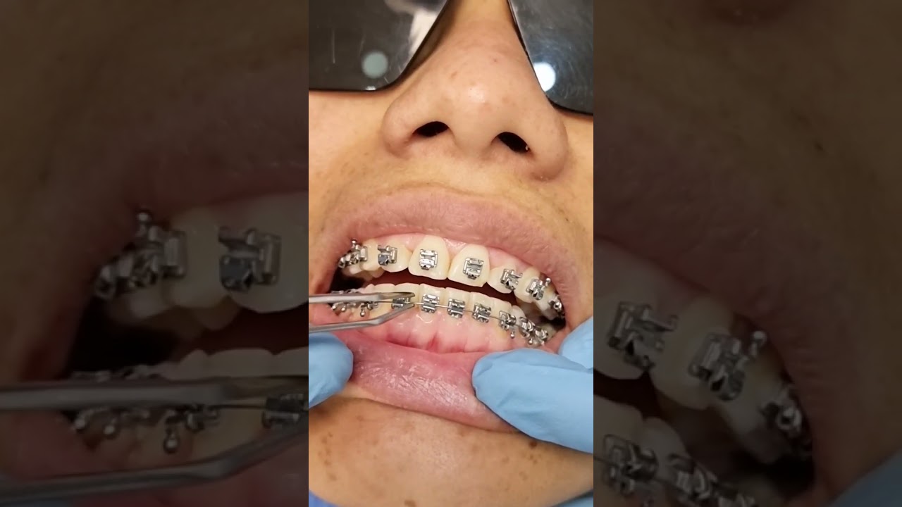Conoce sobre los brackets autoligantes😊🦷