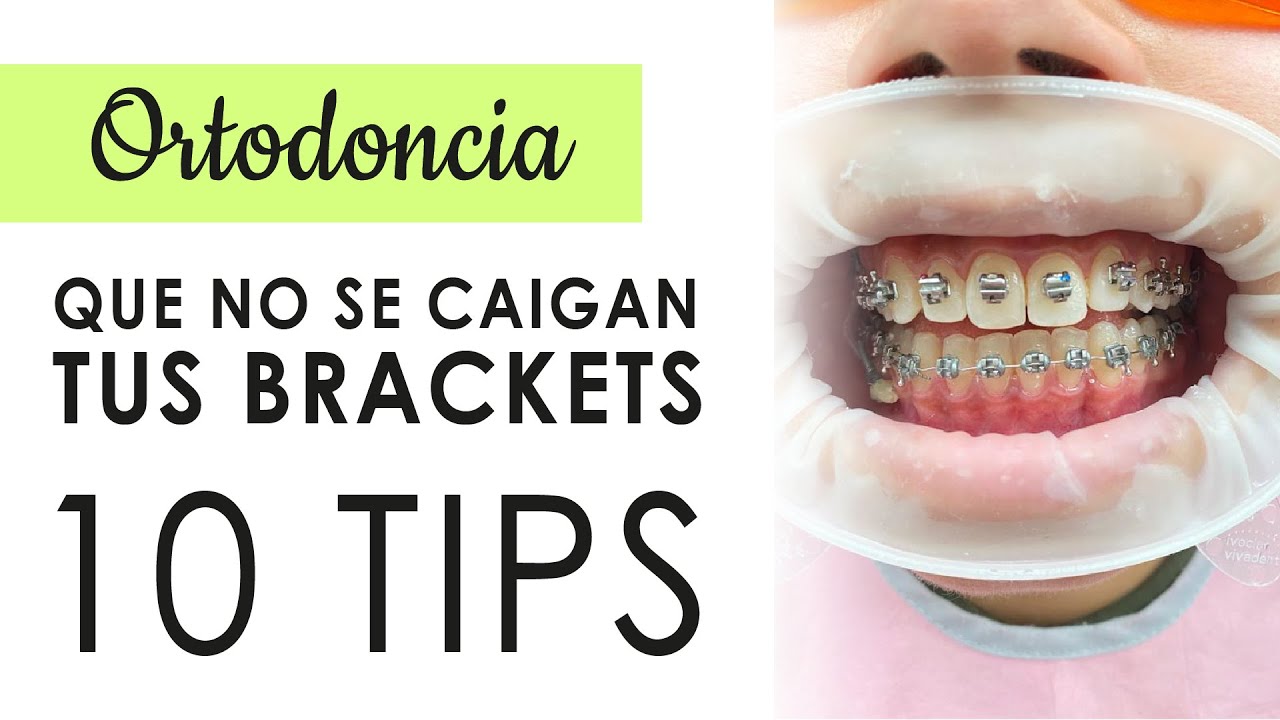10 TIPS PARA QUE NO SE CAIGAN TUS BRACKETS