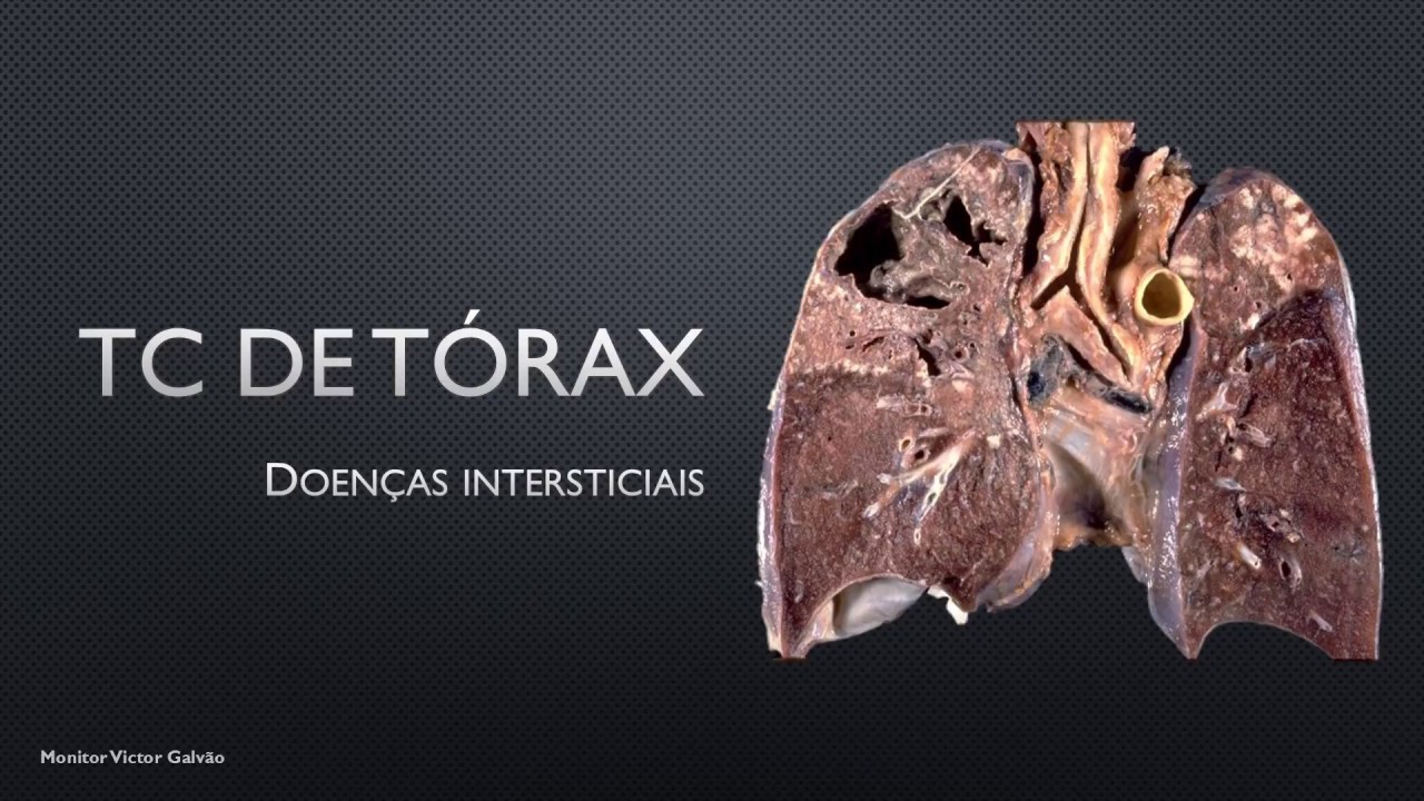Tomografia de tórax - Doenças intersticiais