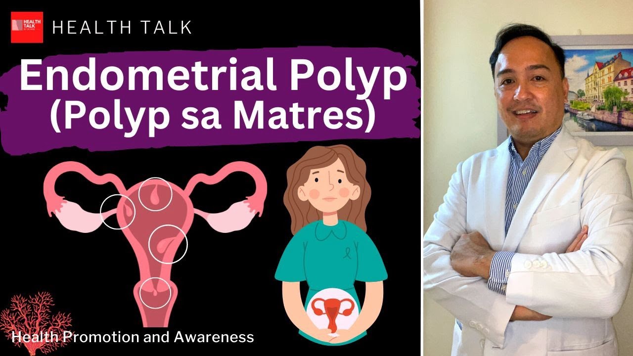 Endometrial Polyp (Polyp sa Matres)