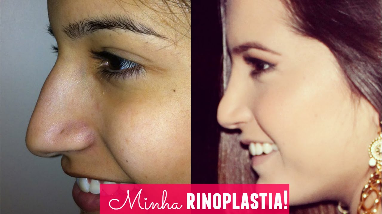 Minha rinoplastia (cirurgia no nariz)