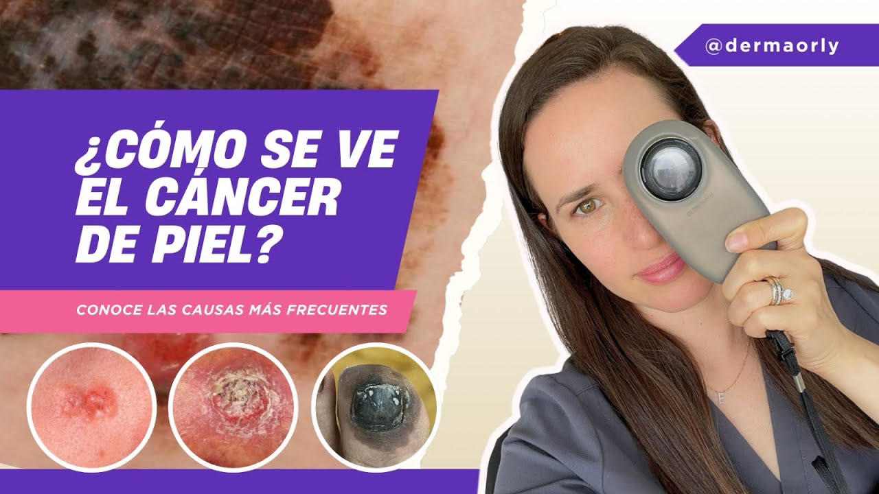 Video sobre el cáncer de piel en este mes de concientización del cáncer de piel