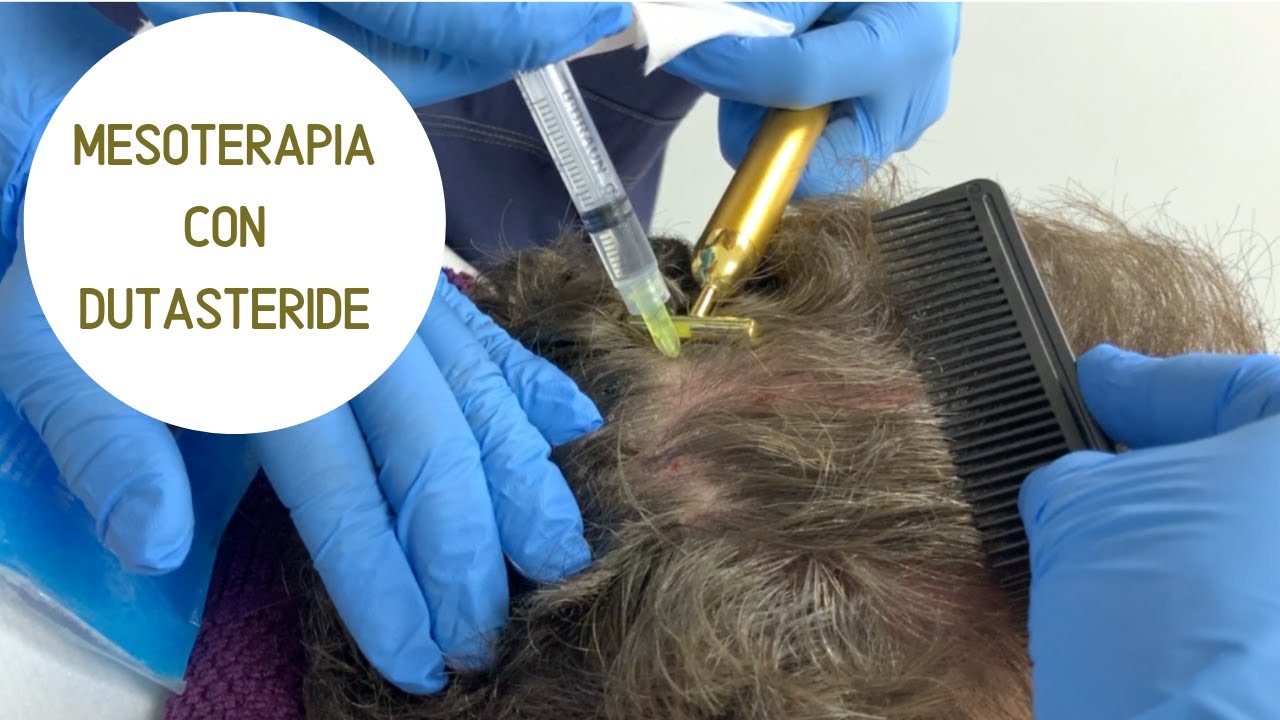 MESOTERAPIA CON DUTASTERIDE: Mi primera sesión