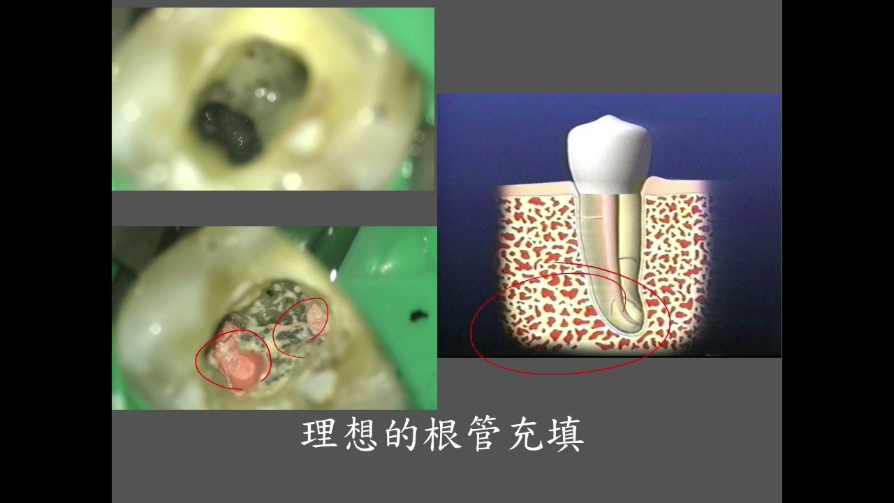 顯微根管治療