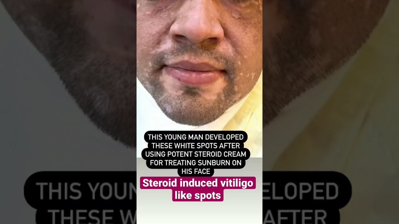 Steroid induced vitiligo like white spots | Dr Ashima Goel |Dermatologist|vitiligo treatment #shorts
