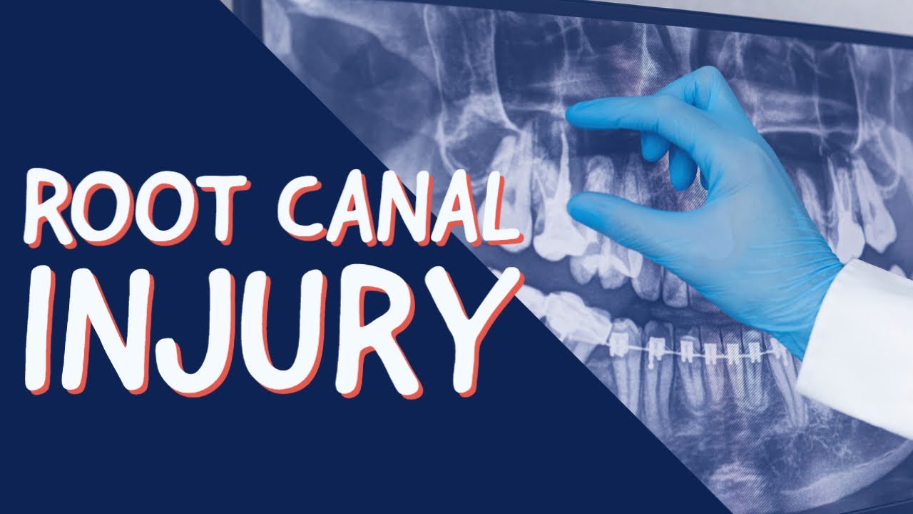 Root Canal Injury - Broken Endodontic Files