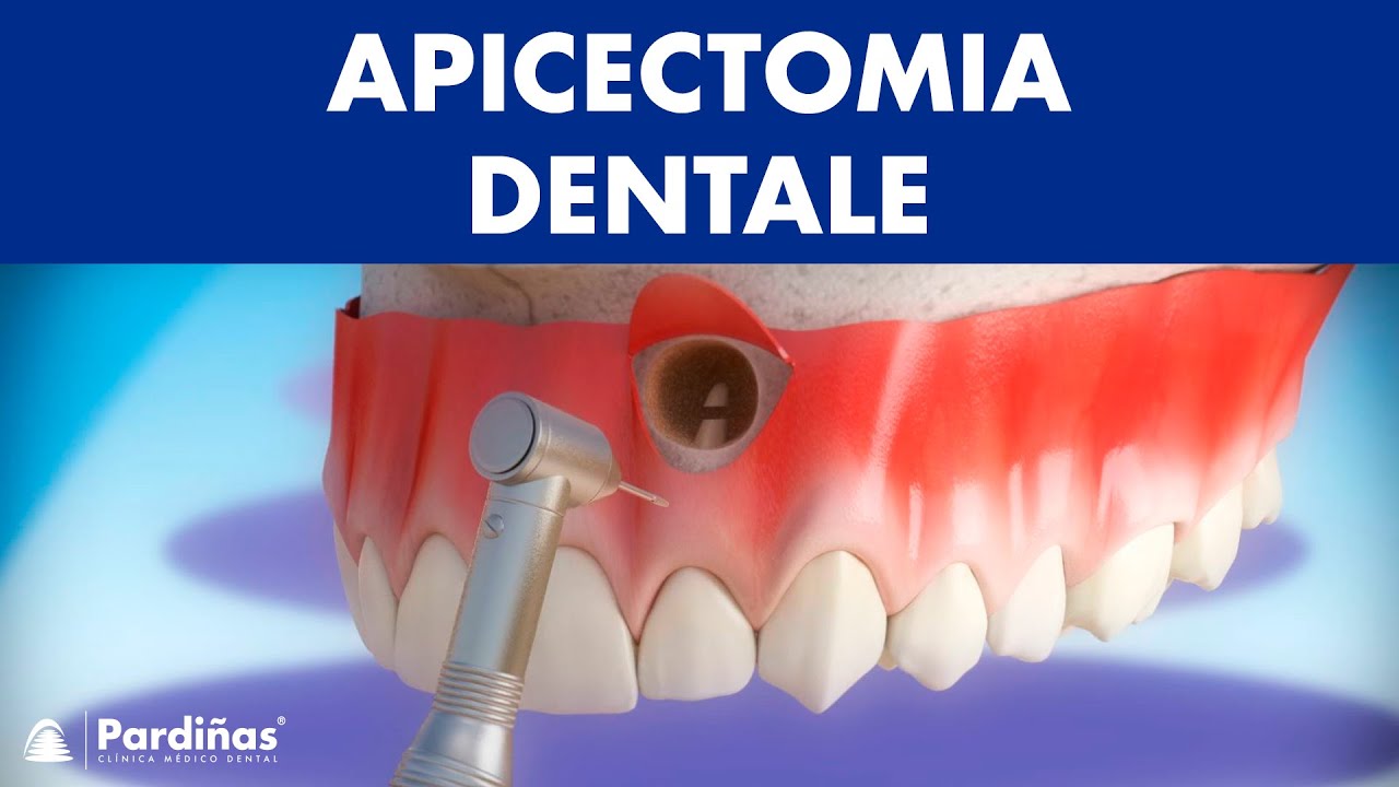 Apicectomia dentale ©
