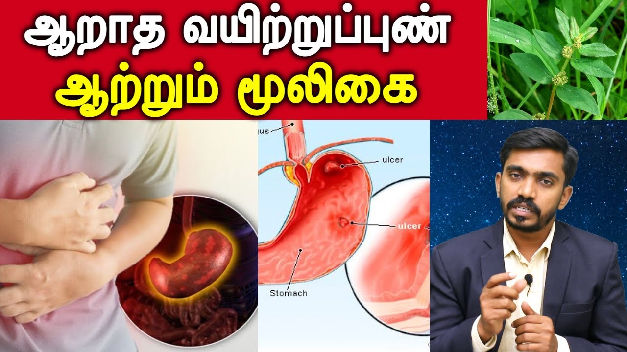 எந்த மருந்திற்கும் குணமாகா அல்சர் எனும் இரைப்பை குண்மத்திற்கு இந்த மூலிகை பயன்படுத்தி பாருங்கள் DrSJ