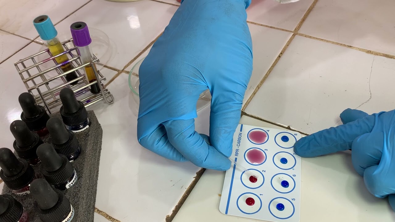 Technique sérologique du widal et Félix