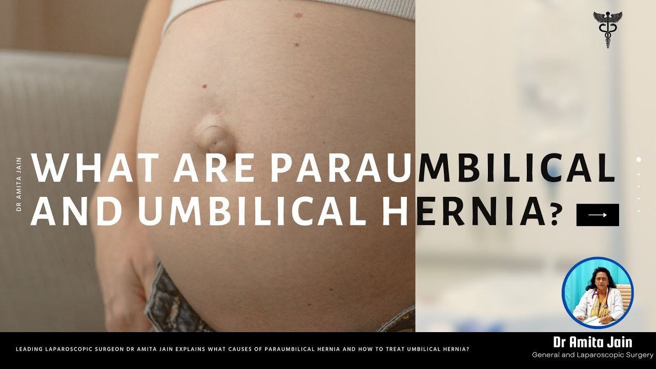 Paraumbilical and Umbilical Hernia Repair Surgery