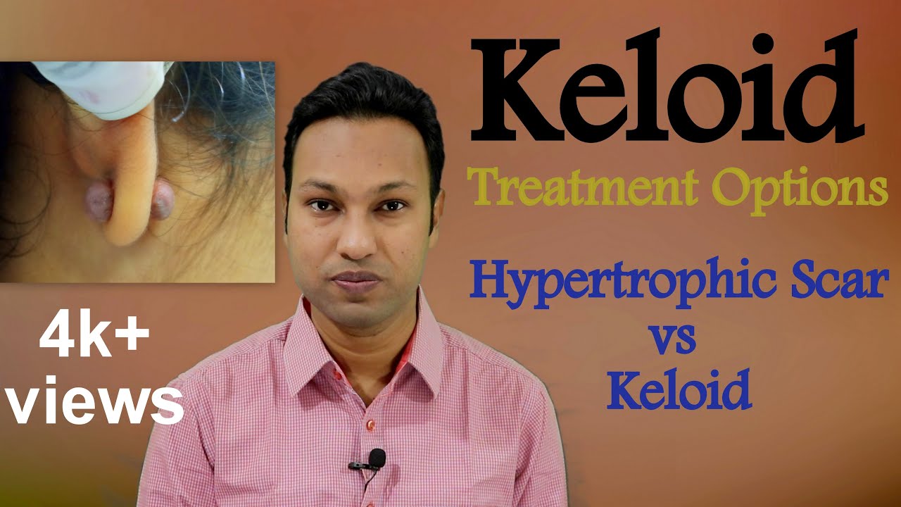 Keloid: Treatment Options । Hypertrophic Scar vs Keloid