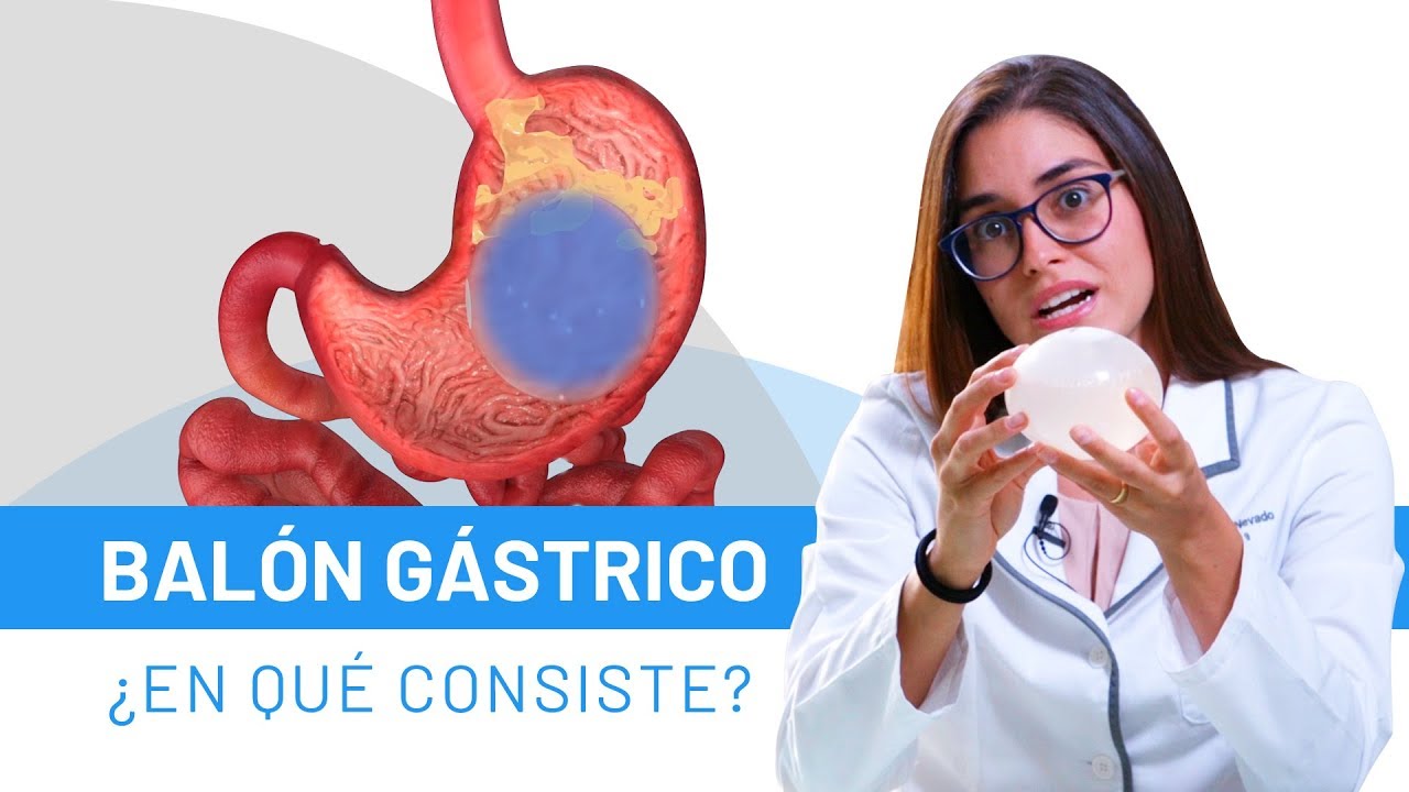 BALÓN GÁSTRICO: Todo lo que necesitas saber | Resuelve tus dudas