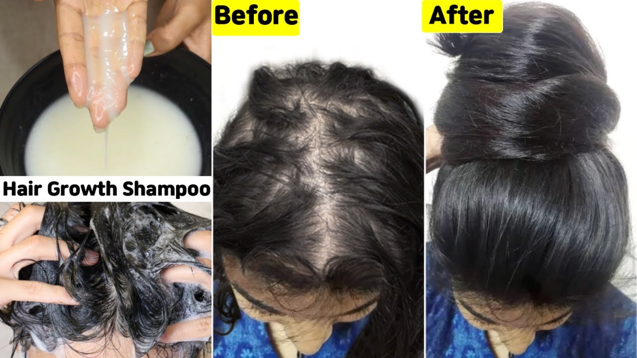 I used this👆🏼Hair Growth Shampoo on Scalp-To Get Thick Dense Hair Growth-Stop Hairfall & Hair Loss
