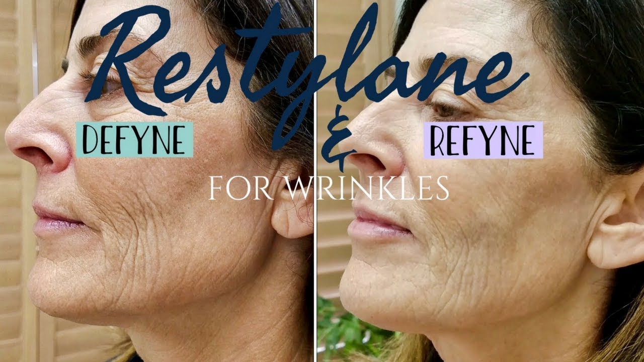 Treating Wrinkles with Restylane Refyne & Defyne | Maintain A Youthful Look with Neotenic Beauty