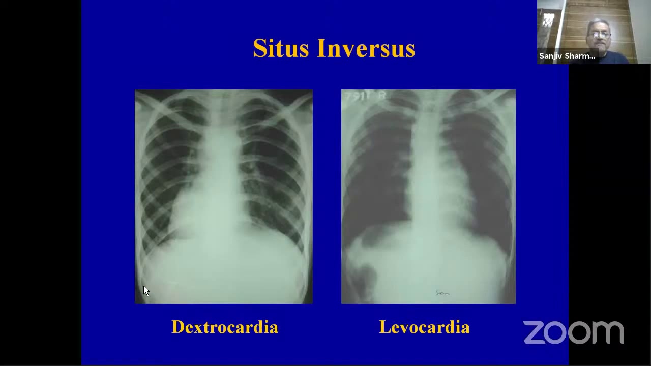 Chest Radio-graphs In Heart Disease  pgtrackdcsi