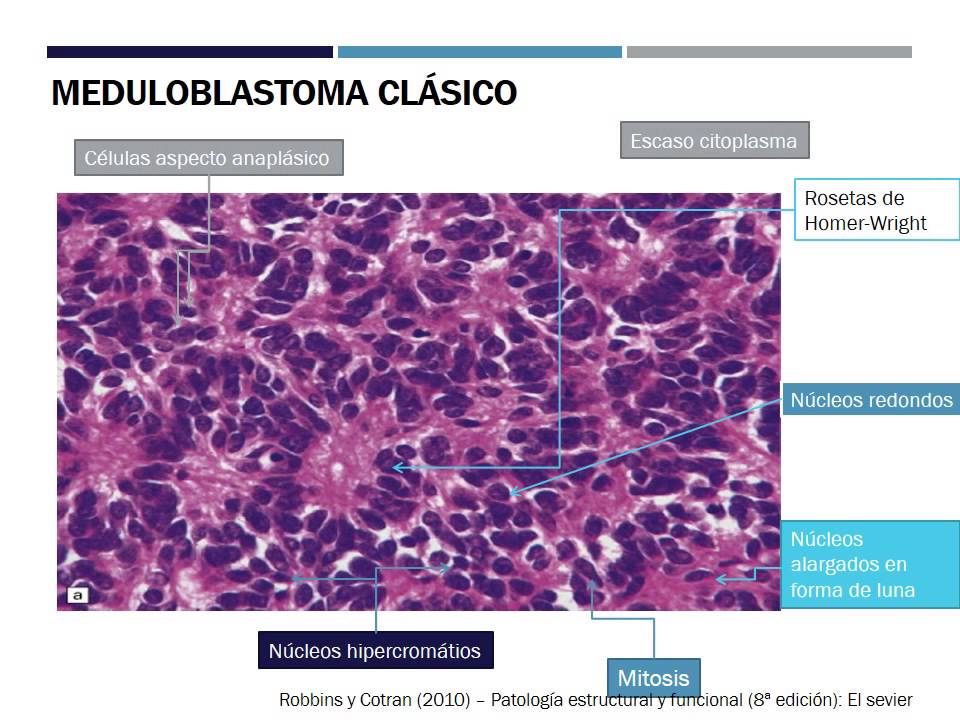 MEDULOBLASTOMA