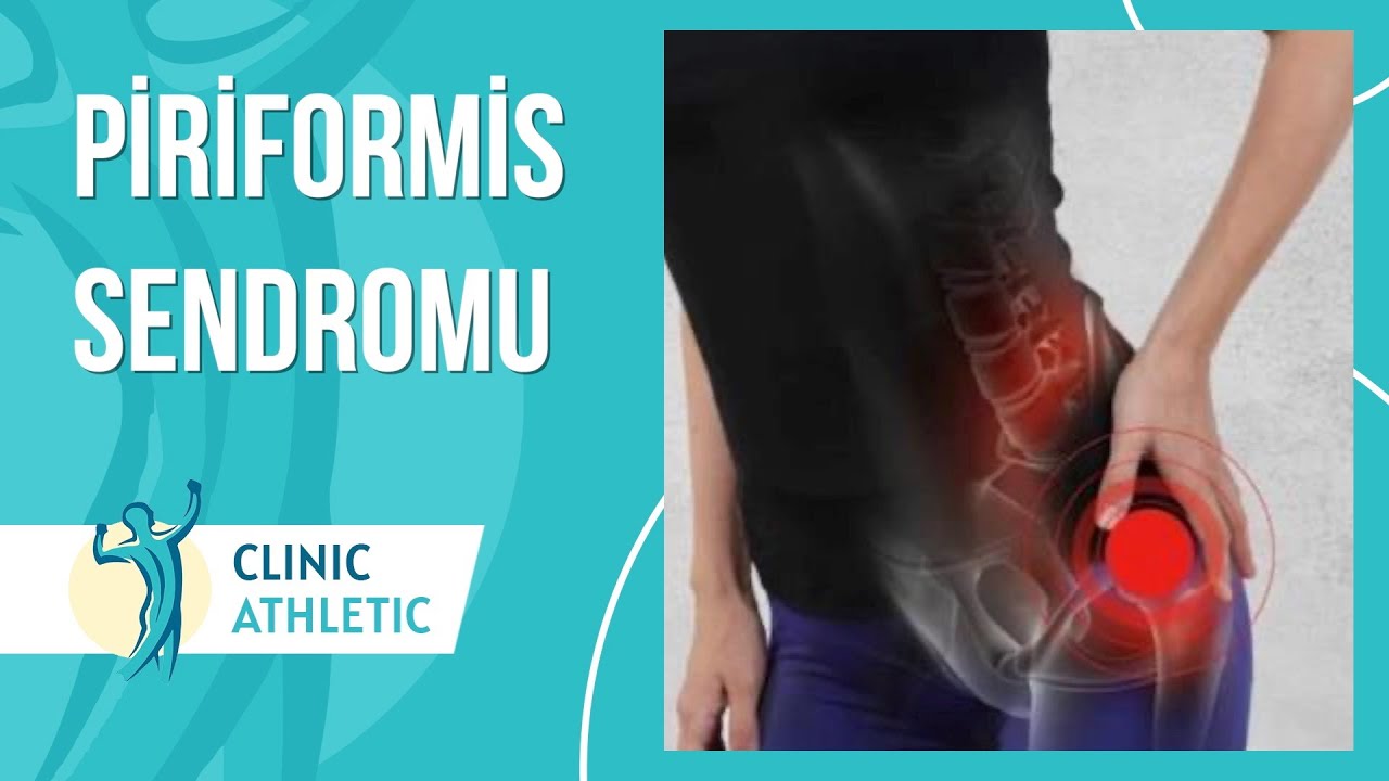 Piriformis Sendromu Nedir? | Ağrı İçin Neler Yapabiliriz?