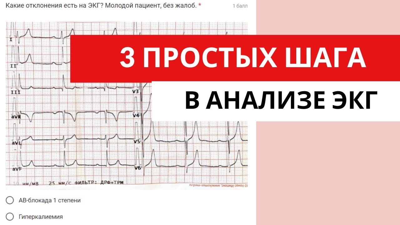 3 простых шага в анализе ЭКГ. Понятный алгоритм анализа ЭКГ.
