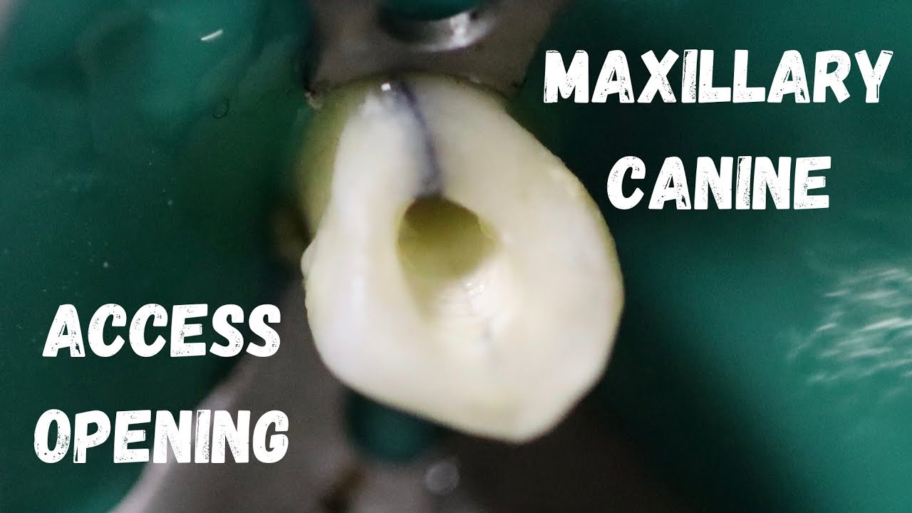 Access Opening of Maxillary Canine | Simulated Demonstration | step by step
