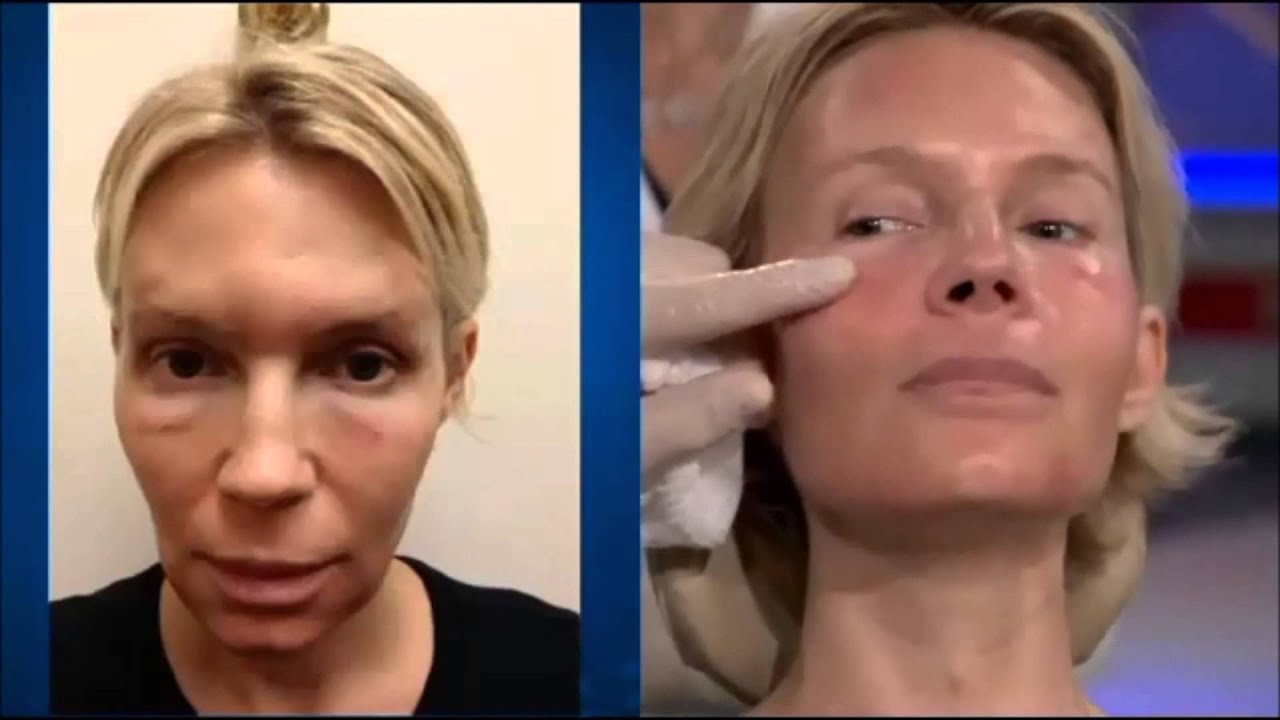 Dr. Ourian Demonstrates Fractora - 'The Mini Face Lift'