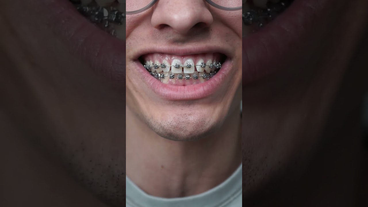 don't eat these 3 things with braces