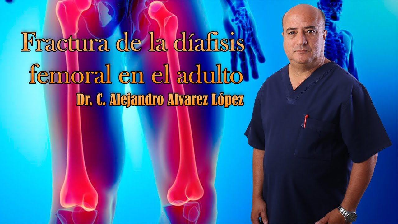 Fractura de la  diáfisis femoral  en el adulto
