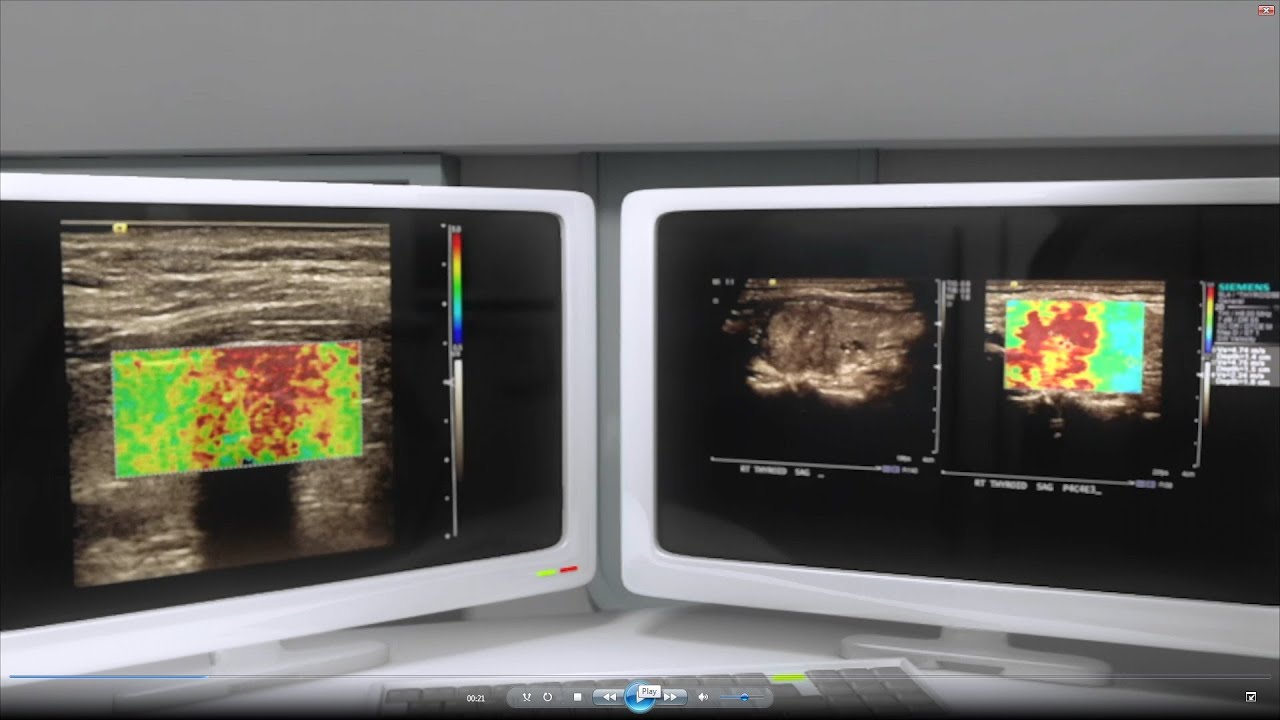 Thyroid Elastography