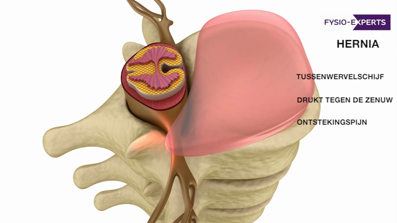 Wat is een hernia in de lage rug (HNP)?