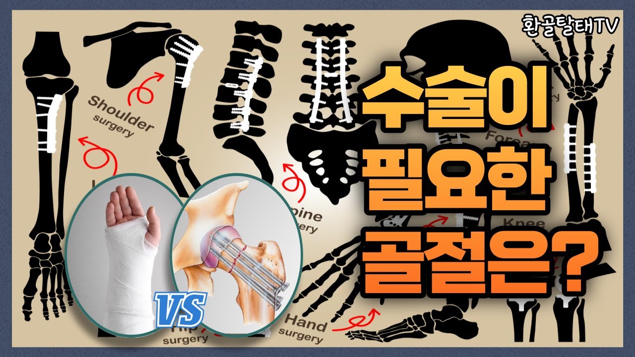[Ep.16] 수술이 필요한 골절?! 🦴 깁스를 할 것인가? 수술을 할 것인가? (수술이 필요한 골절의 종류와 기준, 깁스 치료 vs 수술적 고정, 최근의 경향)