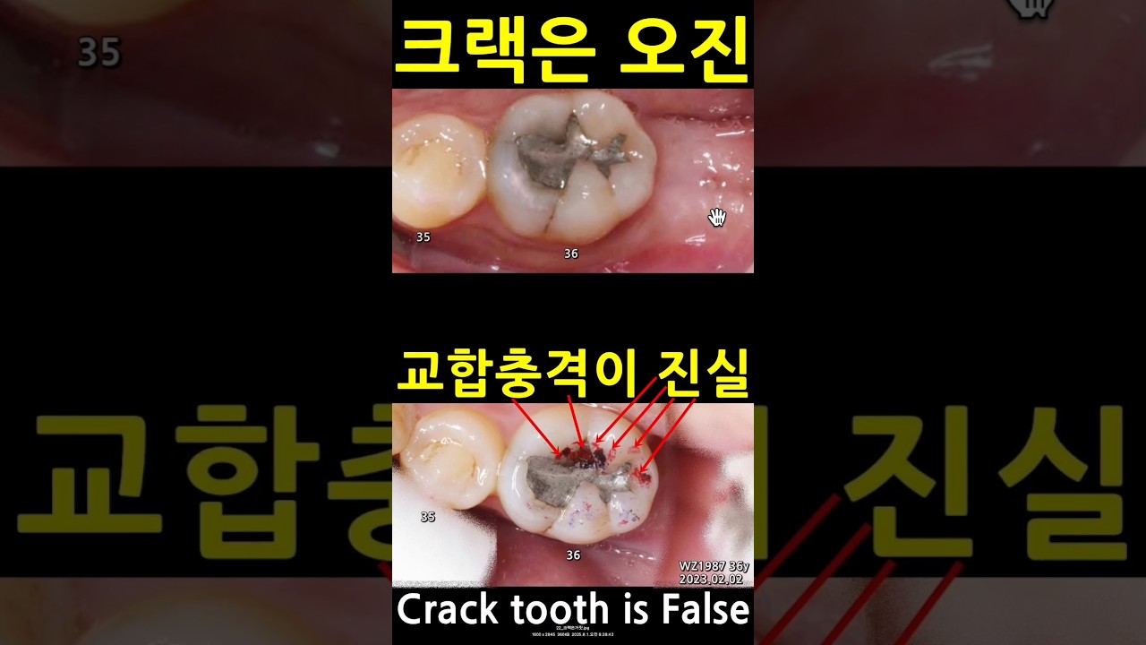 크랙은 오진. 교합충격이 진짜 원인. 교합조정하고 레진수복하면 됨. 신경죽이거나 크라운하면 멍청한 짓. #크랙치아진실 #저작통증 #교합조정 크랙치아36강 2025_08_02