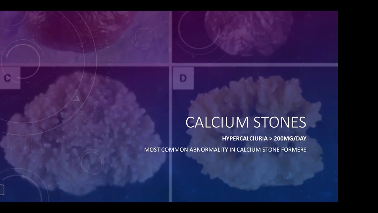Campbell Lecture Series: Urolithiasis