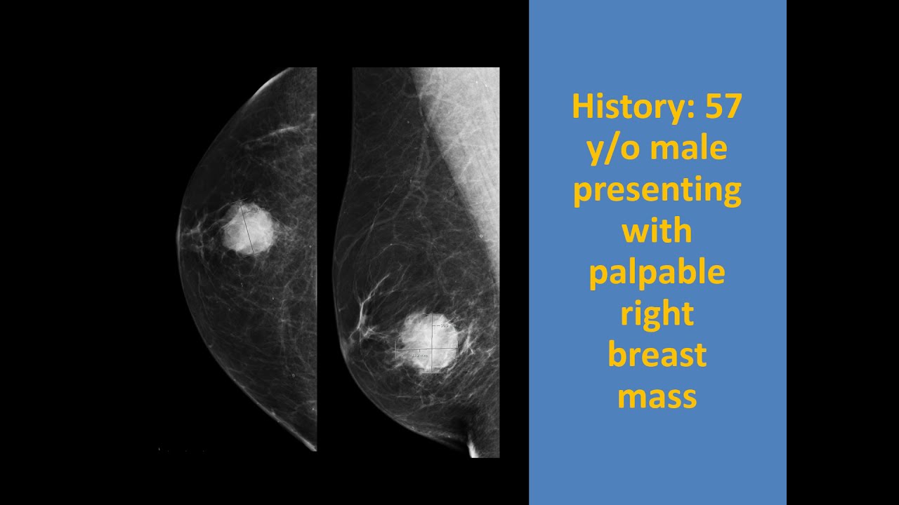 Male Breast Cancer: A Practical Approach