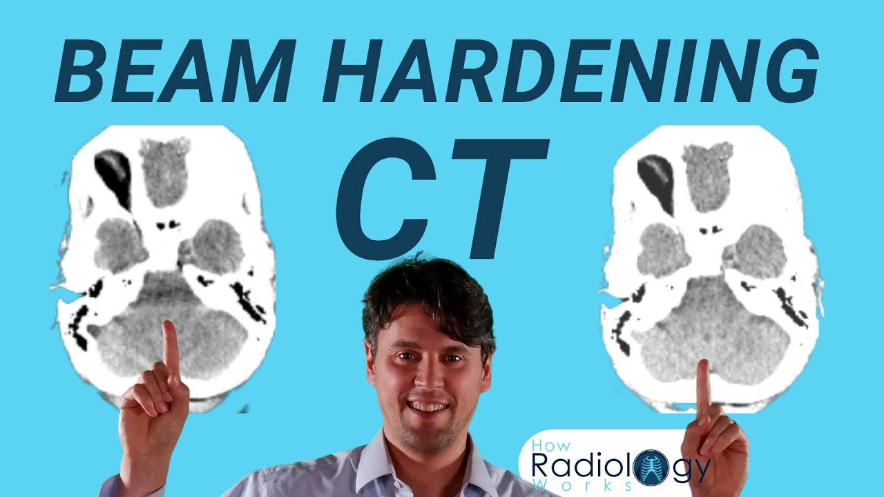 Beam Hardening Artifacts in CT (Single and Dual Energy)