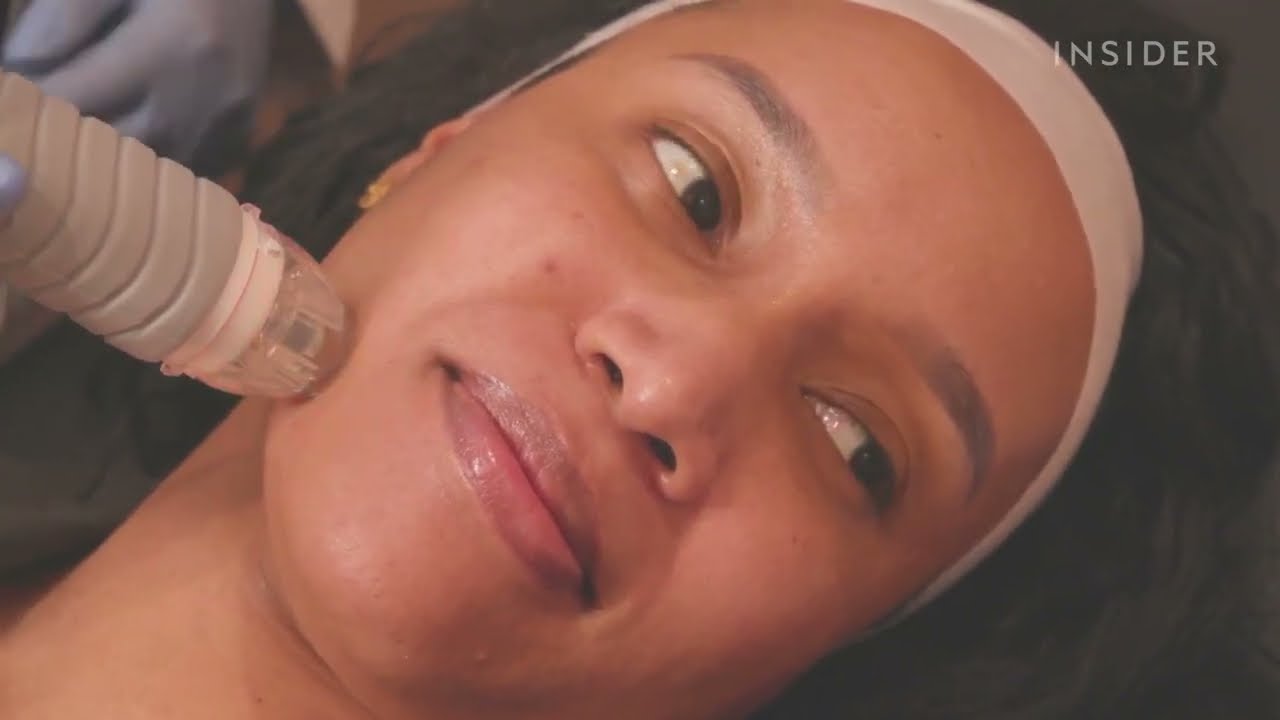 Radio Frequency Microneedling That Is Safe For All Skin Tones