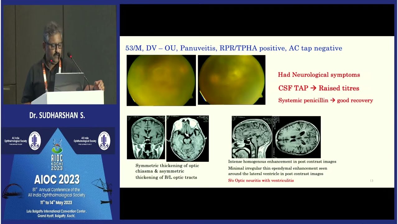 AIOC2023   IC21   topic Dr SUDHARSHAN S  Many faces of syphilitic uveitis