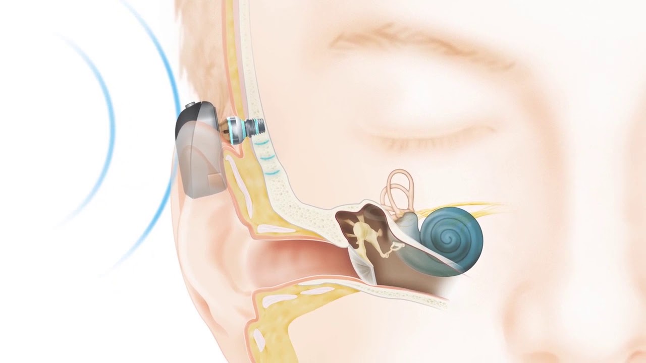 How the Cochlear™ Baha® Connect System works