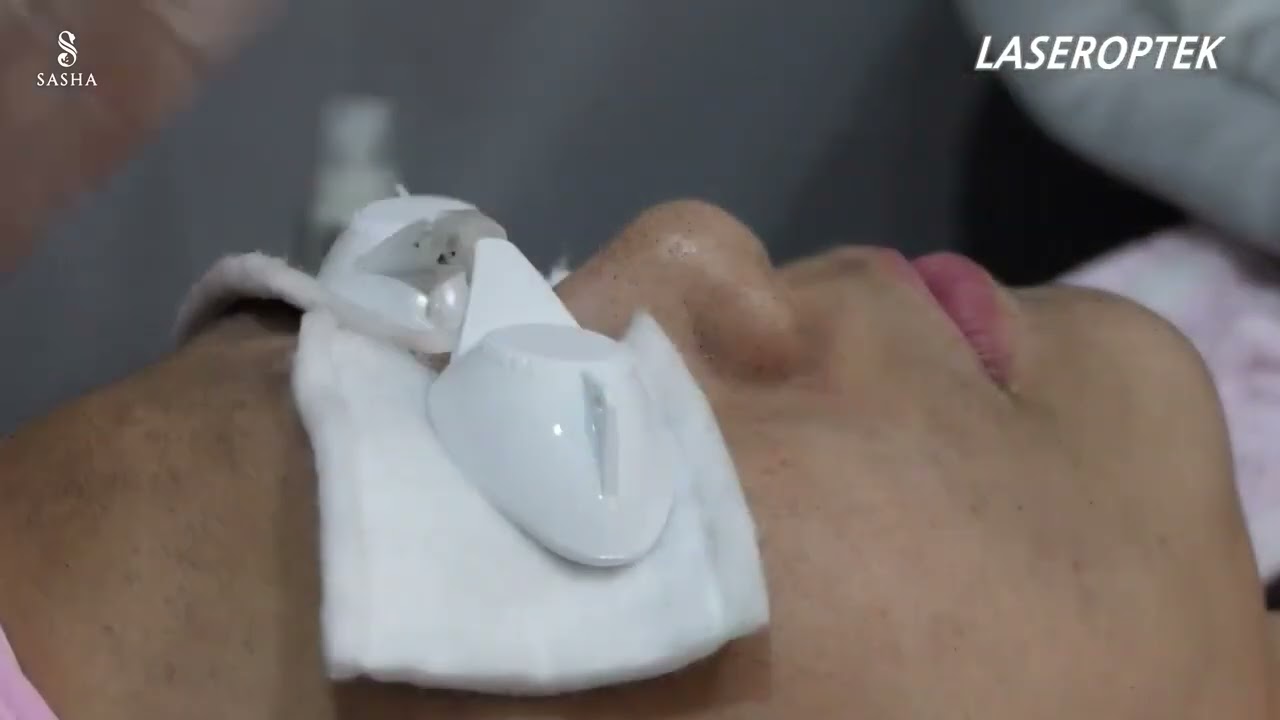 HELIOS III - Carbon Peel Treatment  | Sasha - Luxe Clinic | Hyderabad