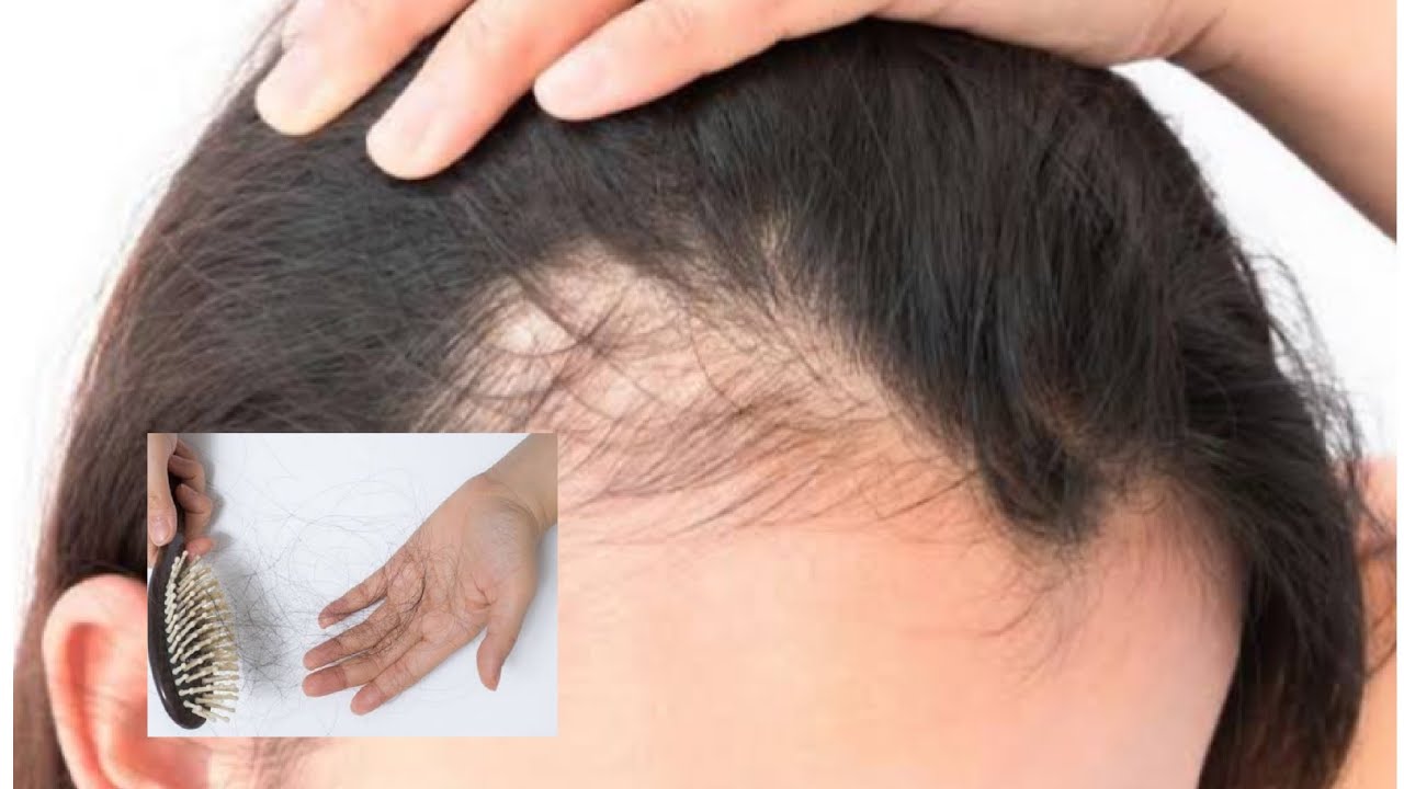 شعرك راه يتساقط.عندك فراغات خاصة من الأمام.قسما بالله من أول إستعمال.حتى الصلع والثعلبةوصفات الجدات