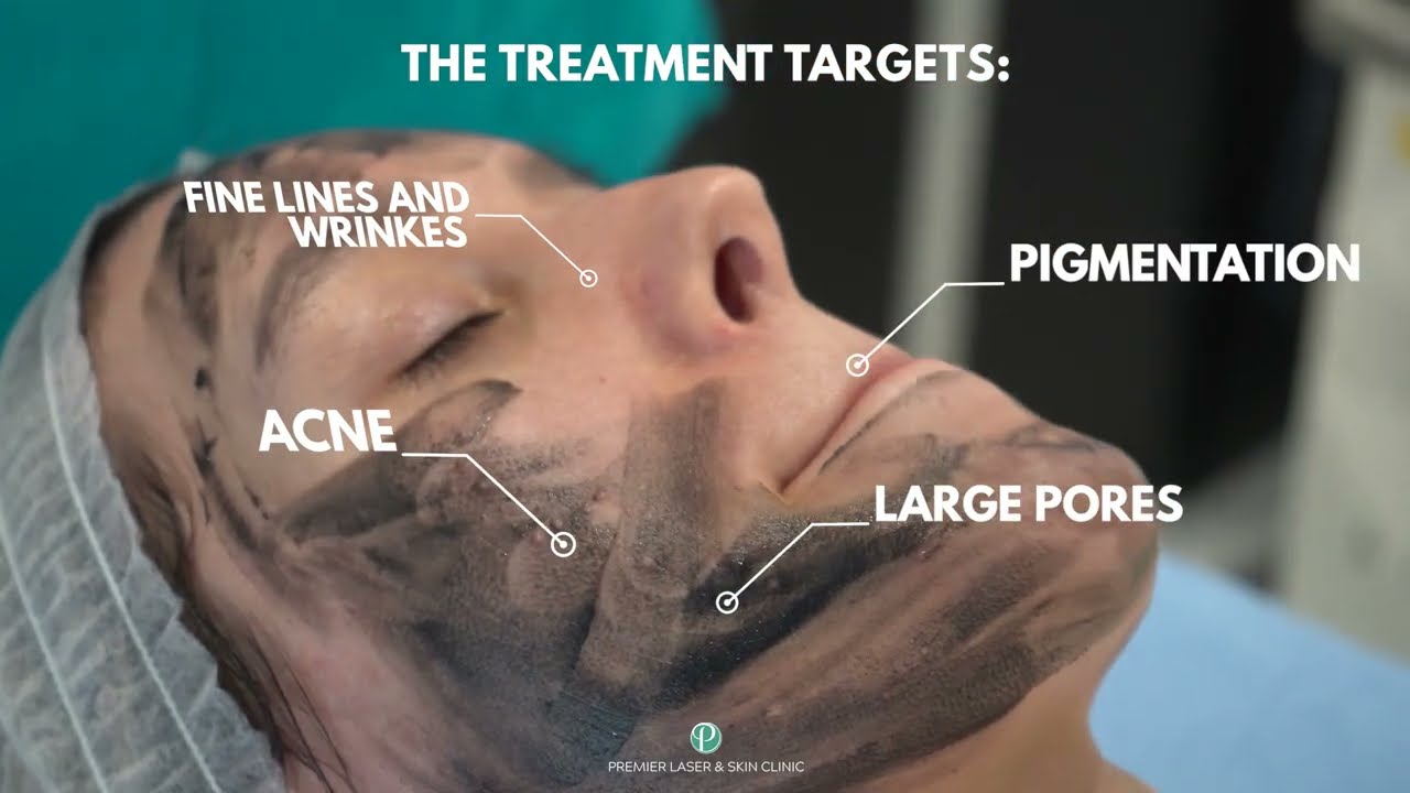 EVERYTHING YOU NEED TO KNOW ABOUT CARBON SPECTRA PEEL (HOLLYWOOD PEEL)